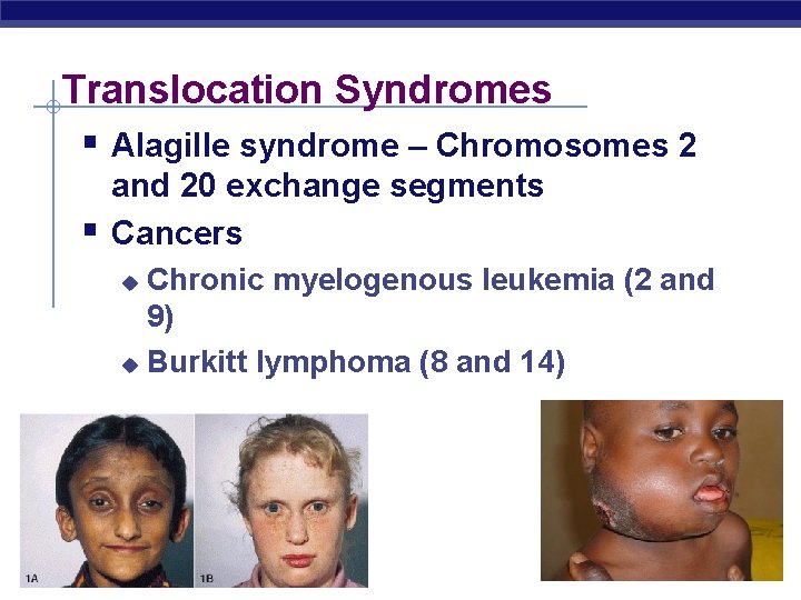 Translocation Syndromes § Alagille syndrome – Chromosomes 2 § and 20 exchange segments Cancers