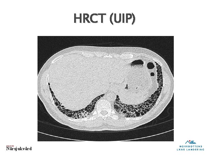 HRCT (UIP) DIVISION Närsjukvård 