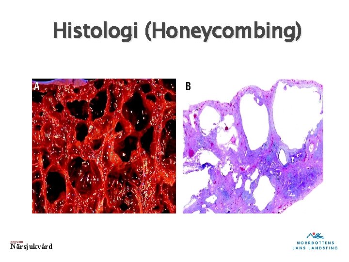 Histologi (Honeycombing) DIVISION Närsjukvård 