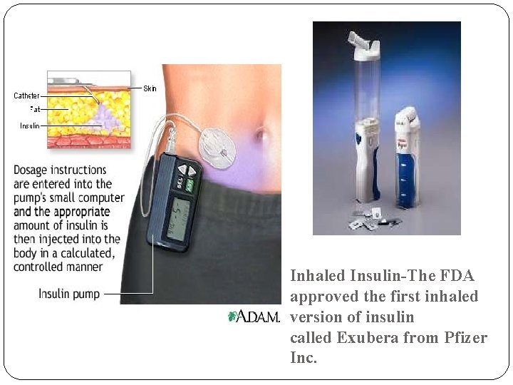 Inhaled Insulin-The FDA approved the first inhaled version of insulin called Exubera from Pfizer