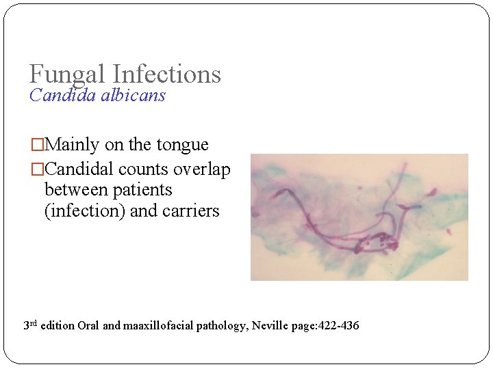 Fungal Infections Candida albicans �Mainly on the tongue �Candidal counts overlap between patients (infection)