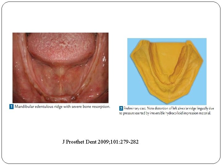 J Prosthet Dent 2009; 101: 279 -282 