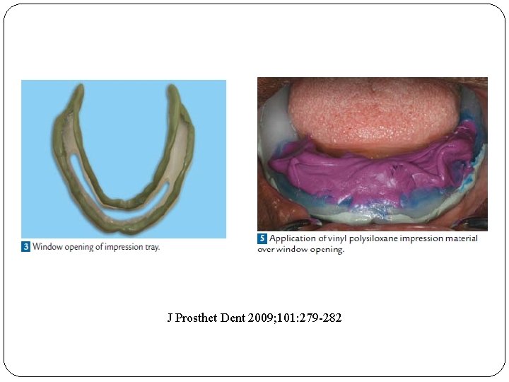 J Prosthet Dent 2009; 101: 279 -282 