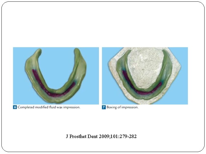 J Prosthet Dent 2009; 101: 279 -282 