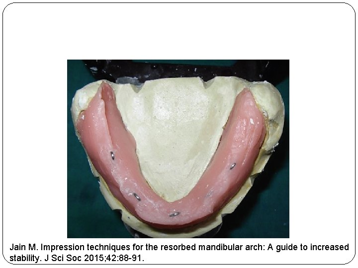 Jain M. Impression techniques for the resorbed mandibular arch: A guide to increased stability.