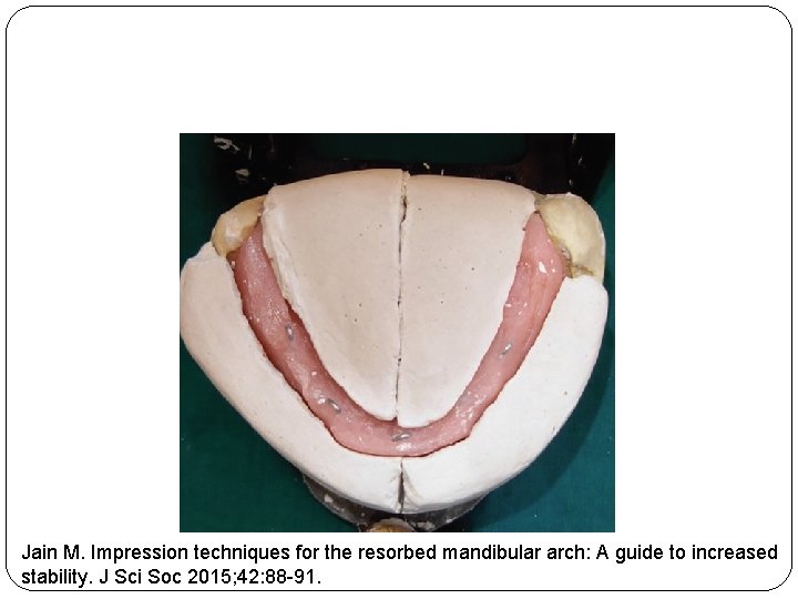 Jain M. Impression techniques for the resorbed mandibular arch: A guide to increased stability.