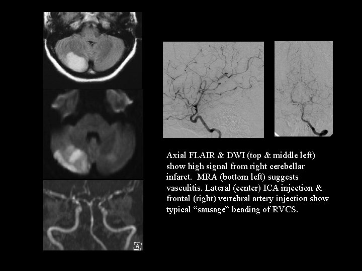Axial FLAIR & DWI (top & middle left) show high signal from right cerebellar