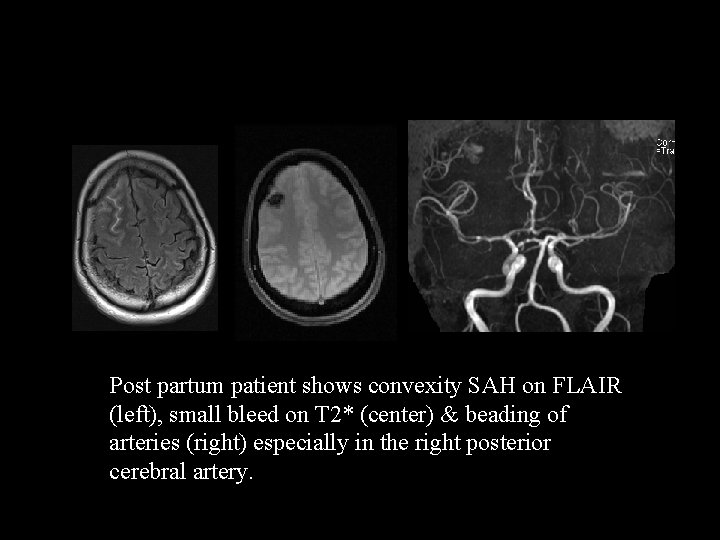 Post partum patient shows convexity SAH on FLAIR (left), small bleed on T 2*