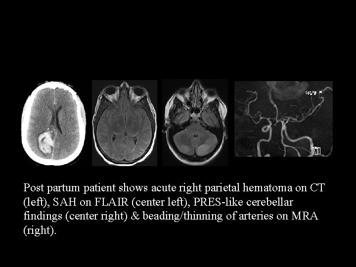 Post partum patient shows acute right parietal hematoma on CT (left), SAH on FLAIR