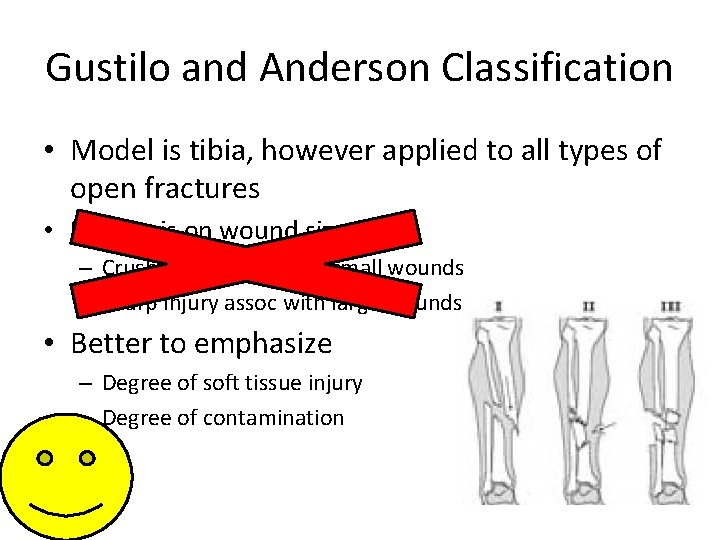 Gustilo and Anderson Classification • Model is tibia, however applied to all types of