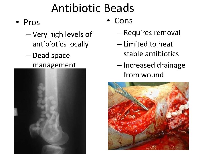 Antibiotic Beads • Pros – Very high levels of antibiotics locally – Dead space