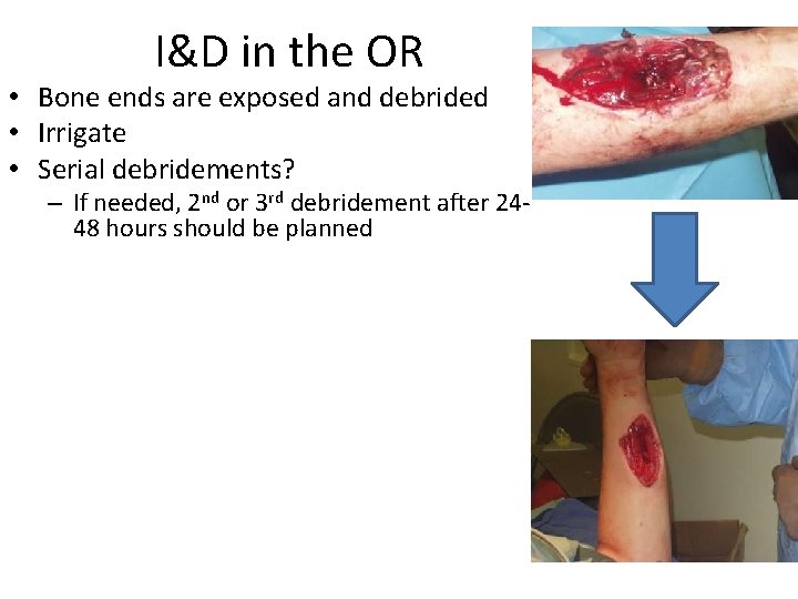 I&D in the OR • Bone ends are exposed and debrided • Irrigate •