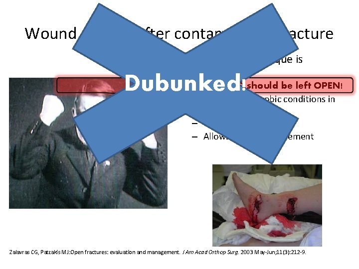 Wound closure after contaminated fracture • Timing and technique is controversial OPEN WOUND should