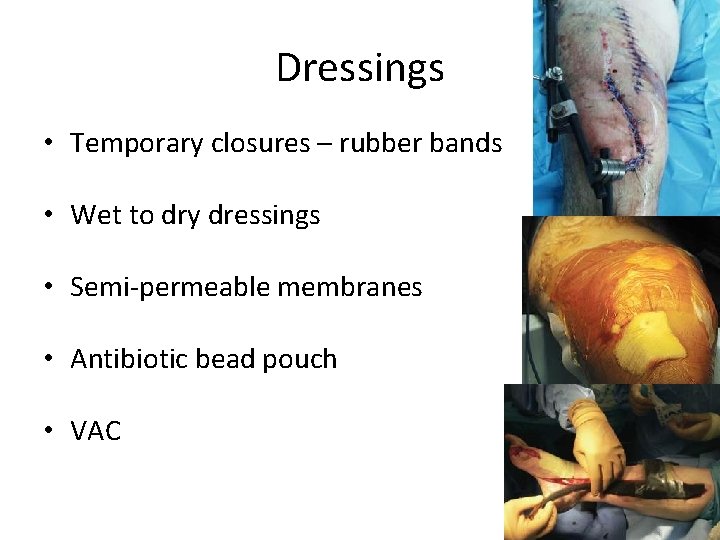 Dressings • Temporary closures – rubber bands • Wet to dry dressings • Semi-permeable