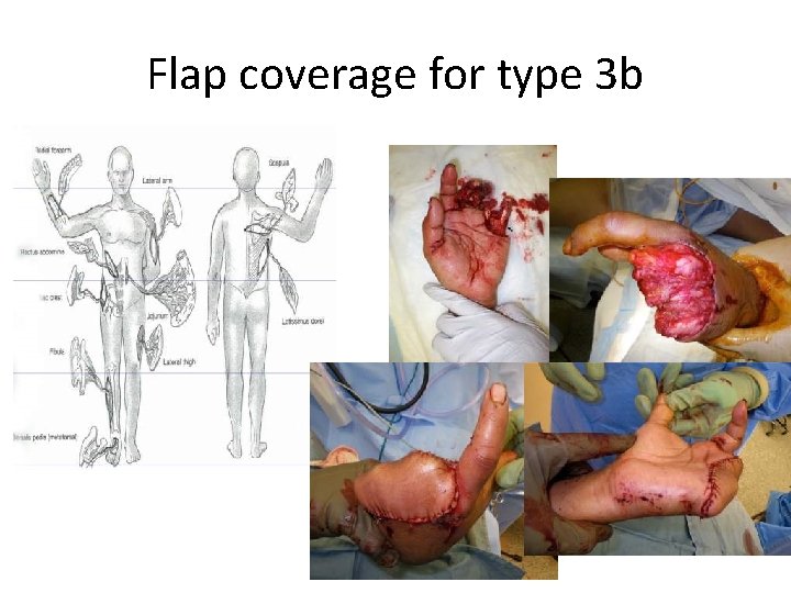 Flap coverage for type 3 b 