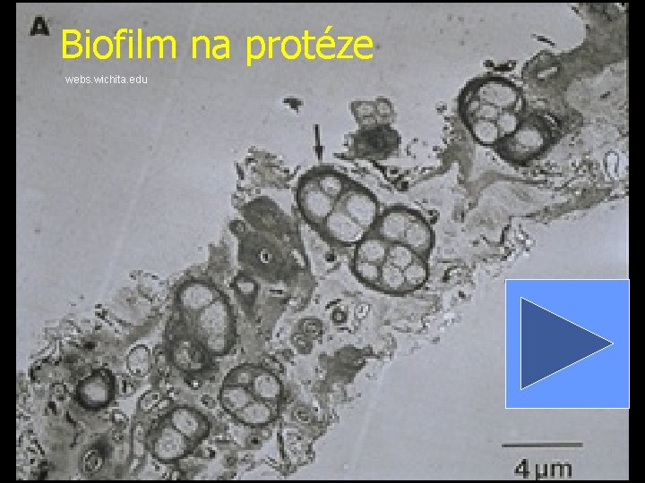 Biofilm na protéze webs. wichita. edu 