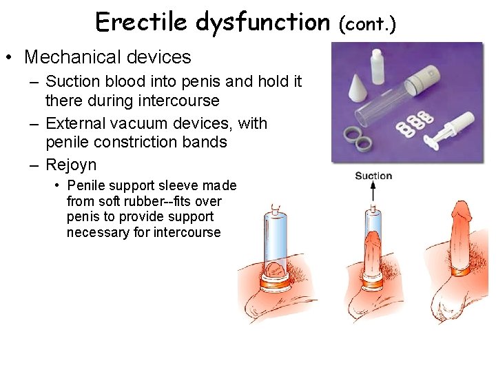 Erectile dysfunction • Mechanical devices – Suction blood into penis and hold it there