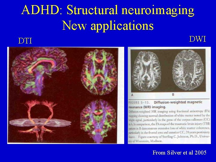 ADHD: Structural neuroimaging New applications DTI DWI From Silver et al 2005 