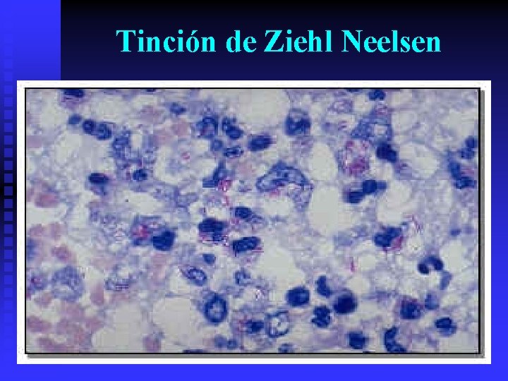 Tinción de Ziehl Neelsen 