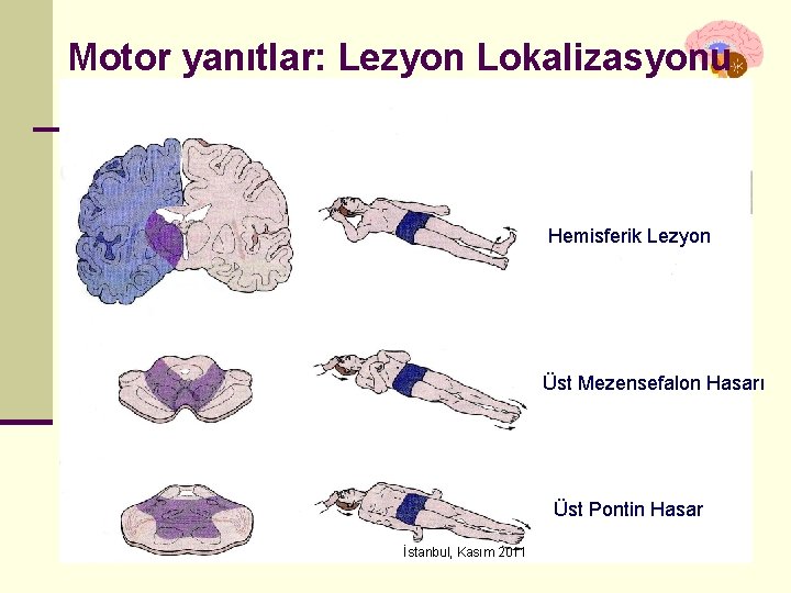 Motor yanıtlar: Lezyon Lokalizasyonu Hemisferik Lezyon Üst Mezensefalon Hasarı Üst Pontin Hasar İstanbul, Kasım