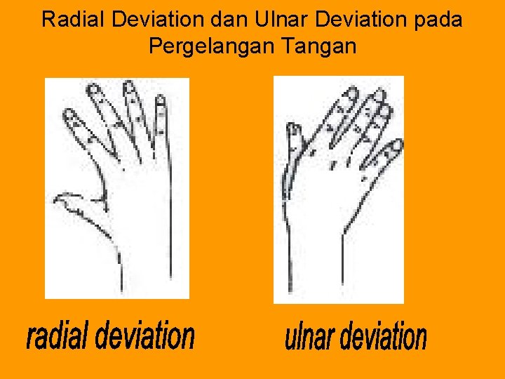 Radial Deviation dan Ulnar Deviation pada Pergelangan Tangan 