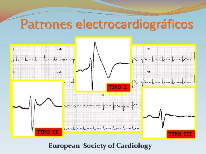 Patrones electrocardiográficos TIPO II European Society of Cardiology TIPO III 