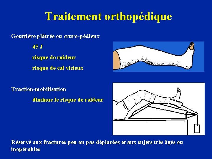 Traitement orthopédique Gouttière plâtrée ou cruro-pédieux 45 J risque de raideur risque de cal