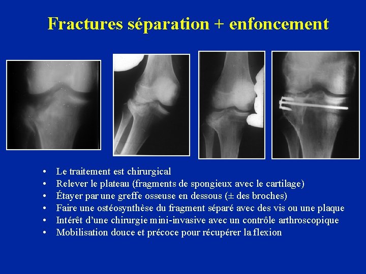 Fractures séparation + enfoncement • • • Le traitement est chirurgical Relever le plateau
