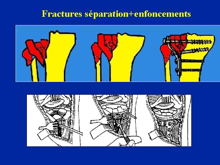 Fractures séparation+enfoncements 