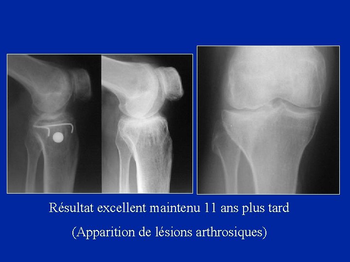 Résultat excellent maintenu 11 ans plus tard (Apparition de lésions arthrosiques) 