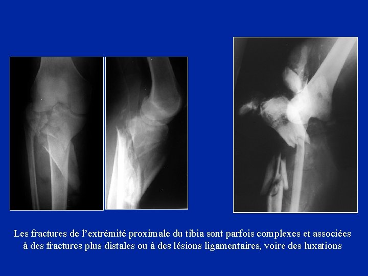 Les fractures de l’extrémité proximale du tibia sont parfois complexes et associées à des