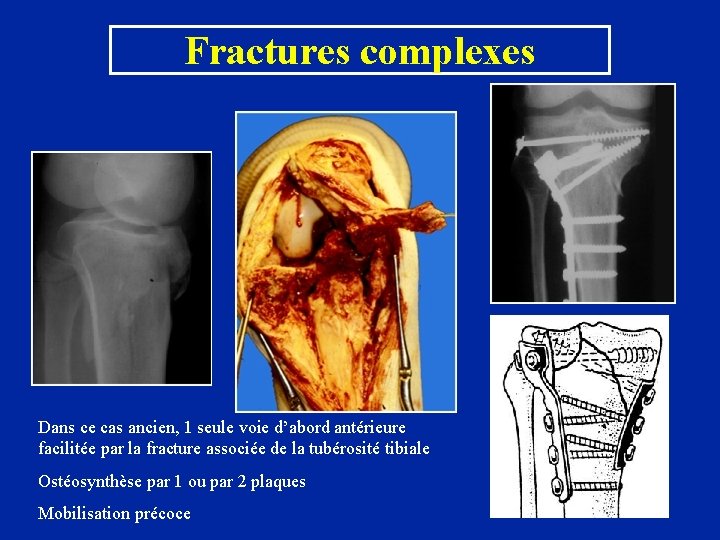 Fractures complexes Dans ce cas ancien, 1 seule voie d’abord antérieure facilitée par la