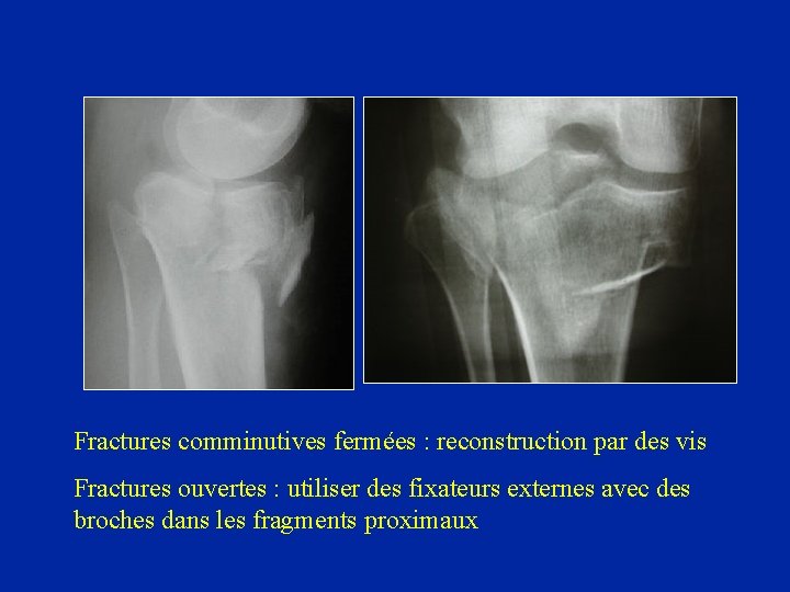 Fractures comminutives fermées : reconstruction par des vis Fractures ouvertes : utiliser des fixateurs