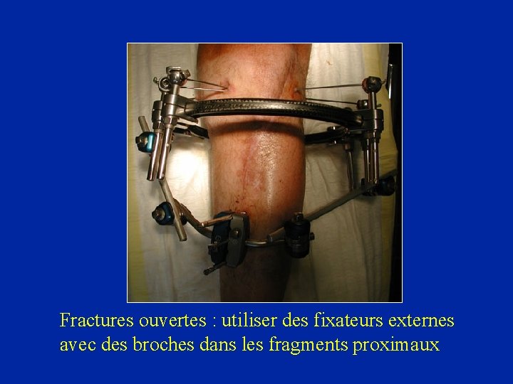 Fractures ouvertes : utiliser des fixateurs externes avec des broches dans les fragments proximaux