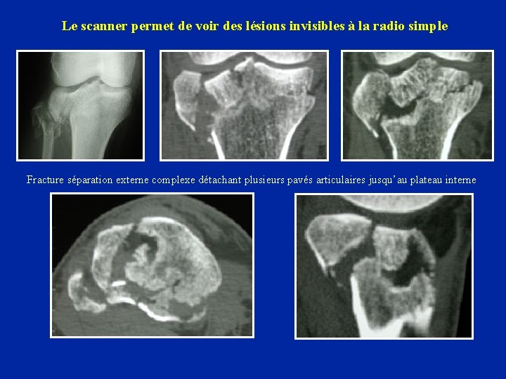 Le scanner permet de voir des lésions invisibles à la radio simple Fracture séparation