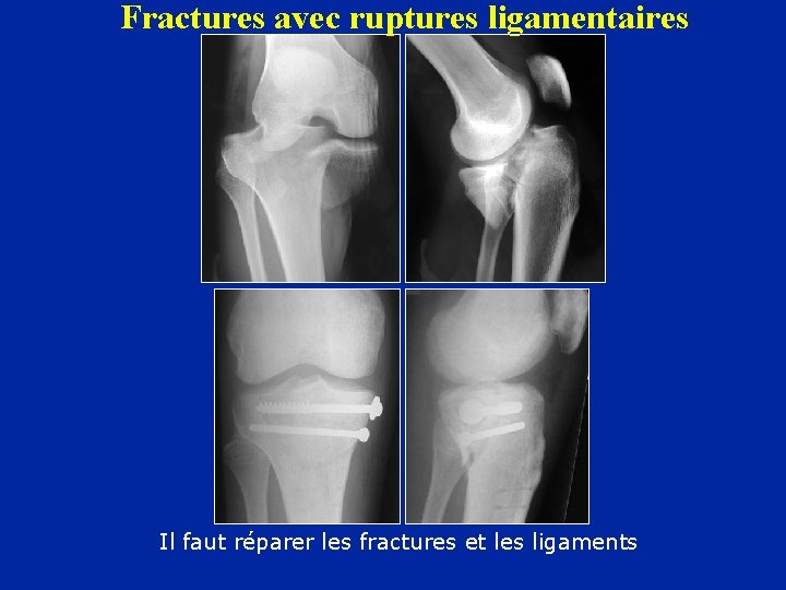 Fractures avec ruptures ligamentaires Il faut réparer les fractures et les ligaments 