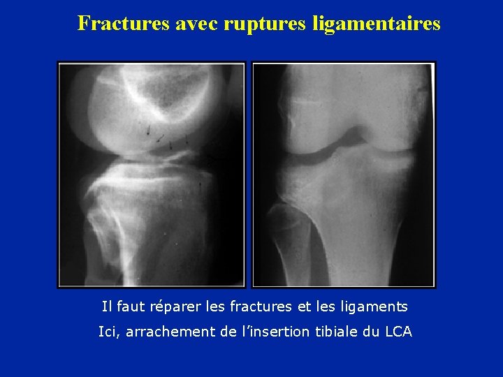 Fractures avec ruptures ligamentaires Il faut réparer les fractures et les ligaments Ici, arrachement