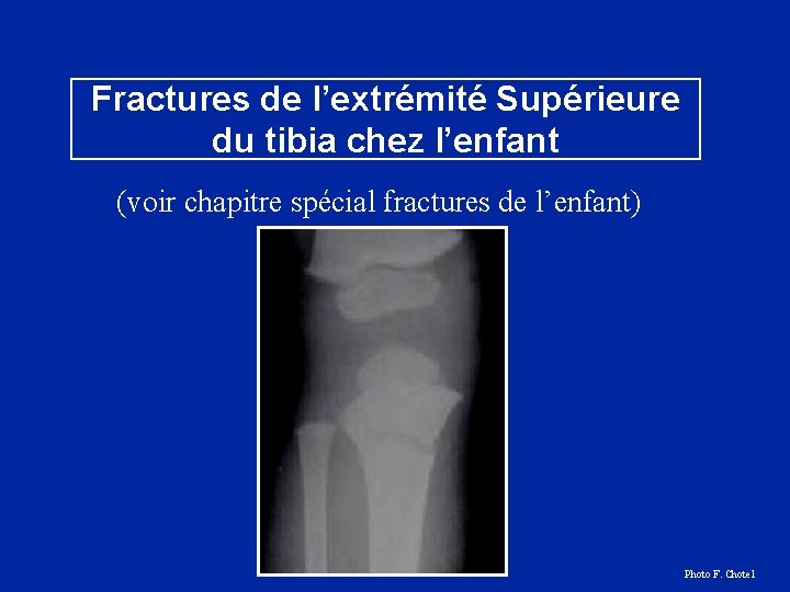 Fractures de l’extrémité Supérieure du tibia chez l’enfant (voir chapitre spécial fractures de l’enfant)