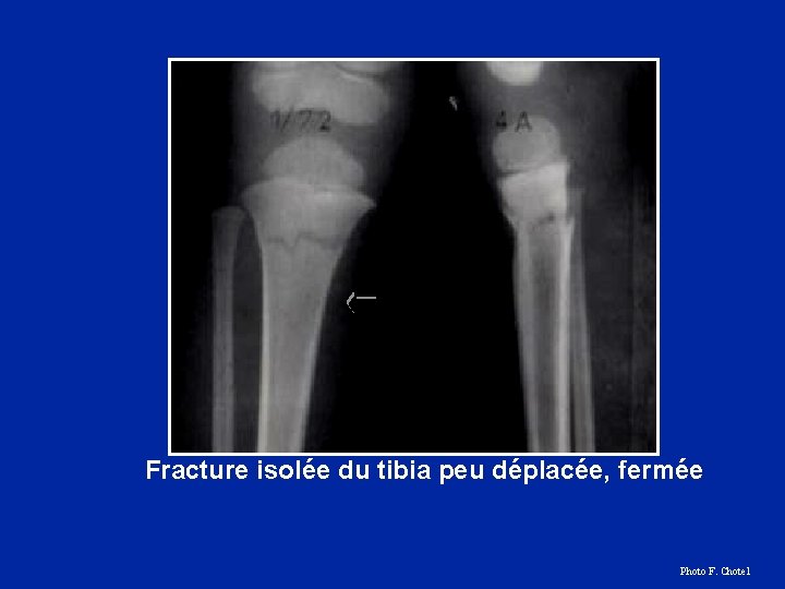 Fracture isolée du tibia peu déplacée, fermée Photo F. Chotel 