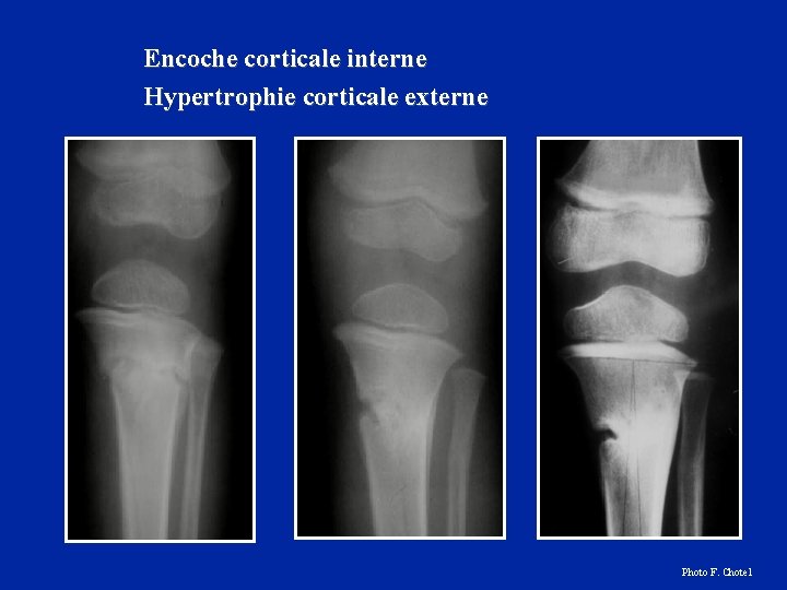 Encoche corticale interne Hypertrophie corticale externe Photo F. Chotel 