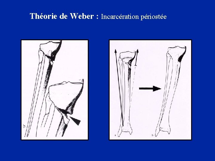 Théorie de Weber : Incarcération périostée 