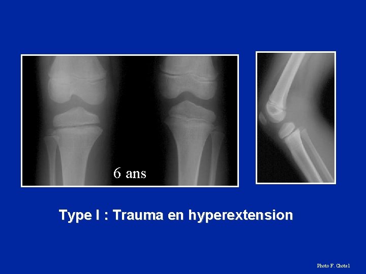 6 ans Type I : Trauma en hyperextension Photo F. Chotel 