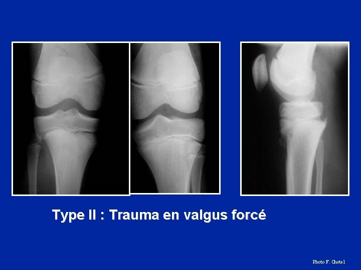 Type II : Trauma en valgus forcé Photo F. Chotel 