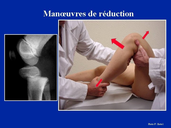 Manœuvres de réduction Photo F. Chotel 