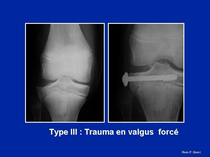 Type III : Trauma en valgus forcé Photo F. Chotel 