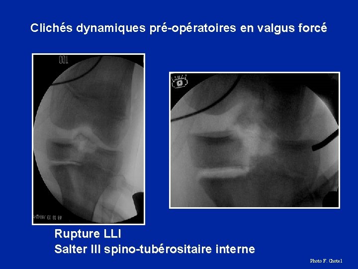Clichés dynamiques pré-opératoires en valgus forcé Rupture LLI Salter III spino-tubérositaire interne Photo F.