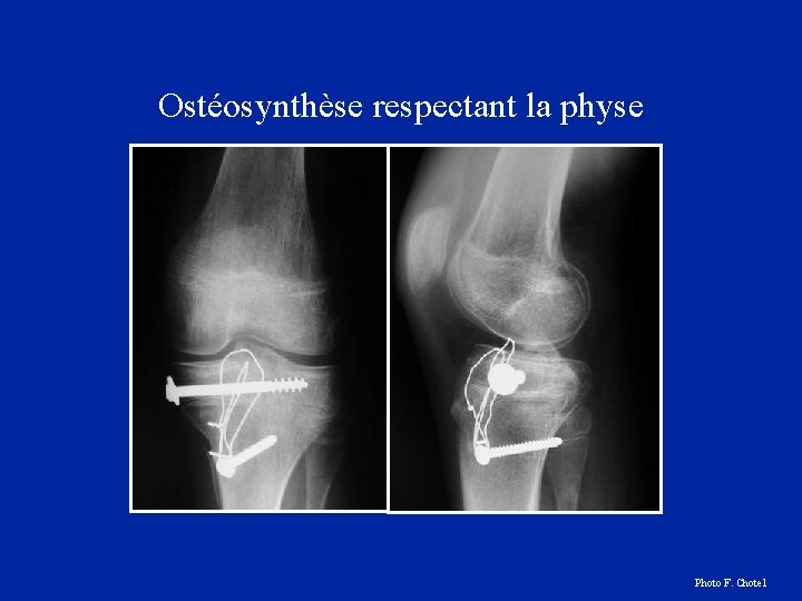 Ostéosynthèse respectant la physe Photo F. Chotel 