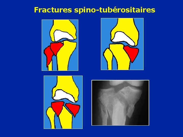 Fractures spino-tubérositaires 