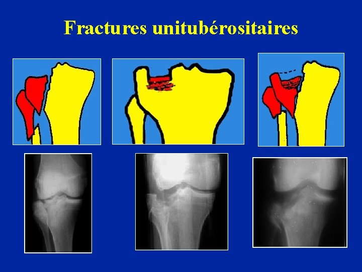 Fractures unitubérositaires 