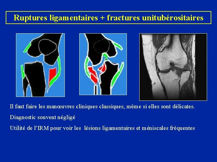 Ruptures ligamentaires + fractures unitubérositaires Il faut faire les manœuvres cliniques classiques, même si